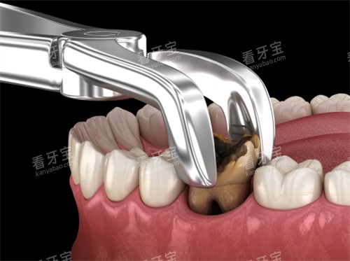拔掉龋坏的牙齿 拔掉龋坏的牙齿