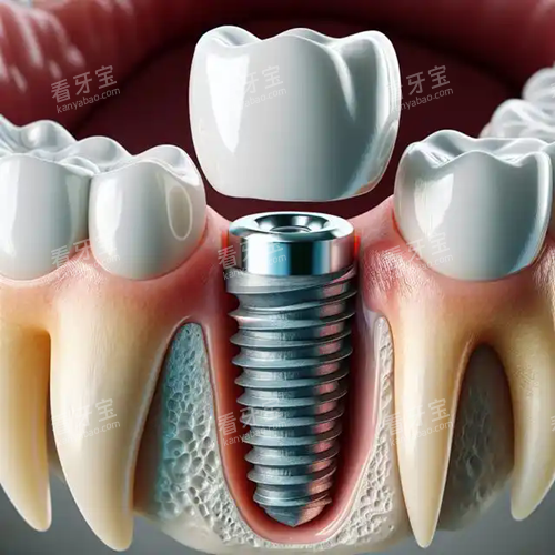 种植牙牙根和原生牙牙根对比.webp 种植牙牙根和原生牙牙根对比.webp