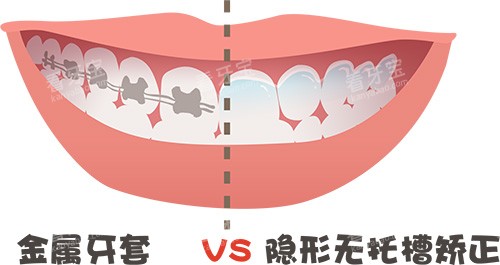 牙齿矫正牙套金属对比隐形牙套 牙齿矫正牙套金属对比隐形牙套