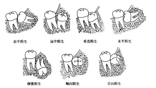 智齿各种阻生示意图 智齿各种阻生示意图