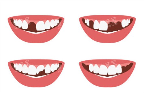 牙齿缺失图 牙齿缺失图