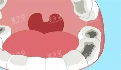 口腔牙齿龋齿动画展示情况 口腔牙齿龋齿动画展示情况