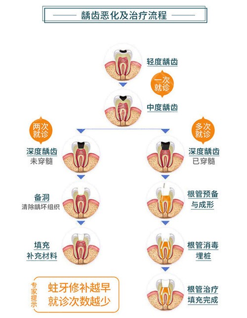 龋齿恶化示意图 龋齿恶化示意图