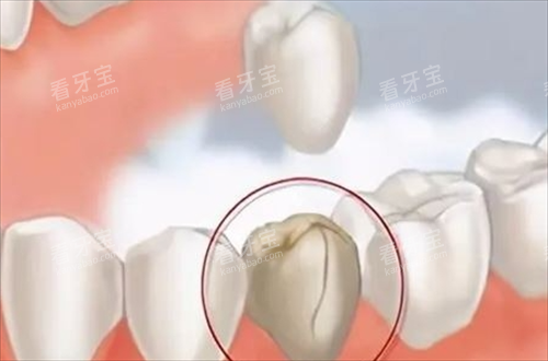 重度龋齿需要做嵌体的情况 重度龋齿需要做嵌体的情况