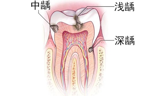 牙齿龋齿深浅图 牙齿龋齿深浅图