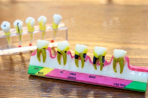 武汉好大夫口腔龋齿模型 武汉好大夫口腔龋齿模型