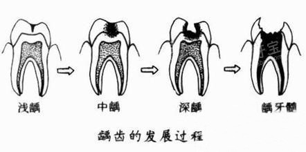 龋齿的发展过程示意图 龋齿的发展过程示意图