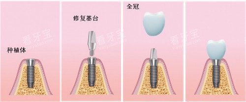 种植牙过程漫画图 种植牙过程漫画图