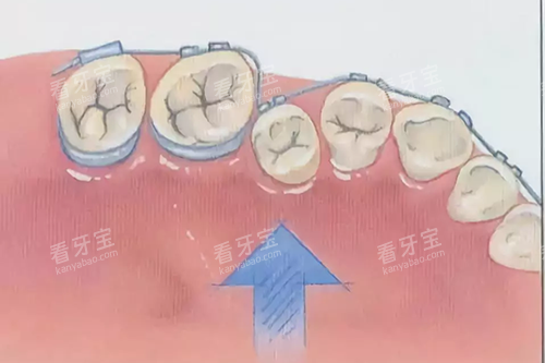 牙齿矫正示意图 牙齿矫正示意图