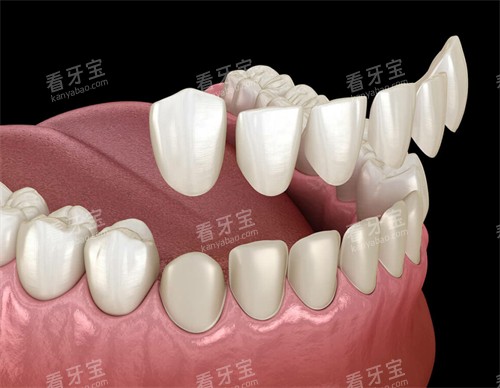 牙齿贴面改善牙齿颜色和形状 牙齿贴面改善牙齿颜色和形状