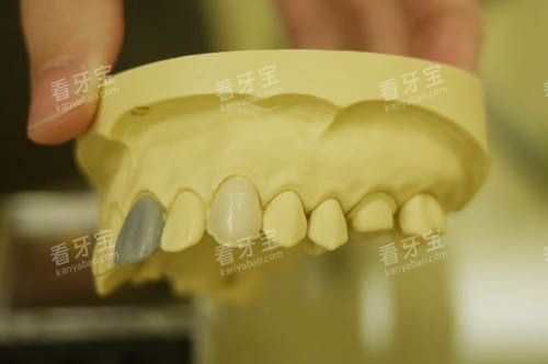 牙齿模具 牙齿模具
