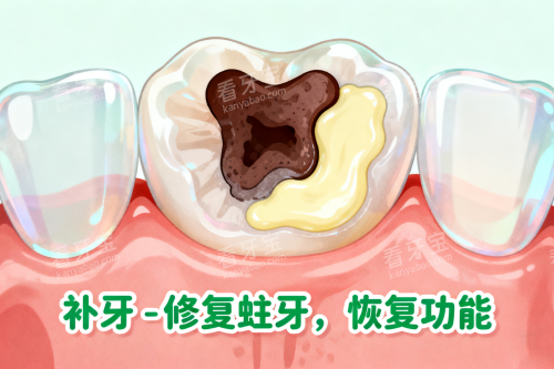 牙齿蛀牙修复展示图 牙齿蛀牙修复展示图