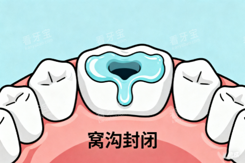 牙齿窝沟封闭展示图 牙齿窝沟封闭展示图