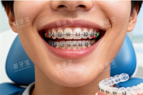 儿童牙齿矫正图片 儿童牙齿矫正图片
