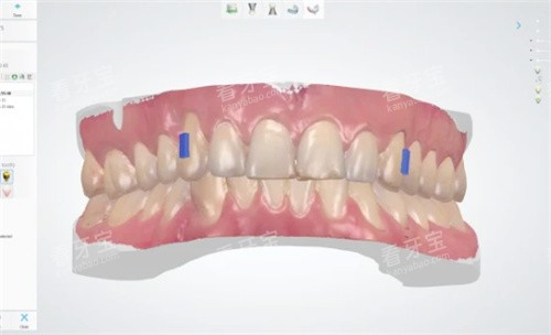 牙齿矫正方案设计中 牙齿矫正方案设计中