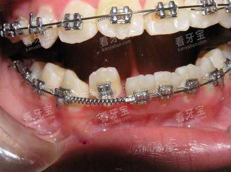 牙齿矫正正畸推簧口内展示图 牙齿矫正正畸推簧口内展示图