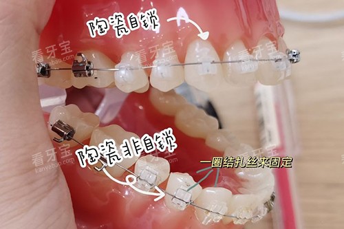 牙齿矫正陶瓷自锁托槽和非自锁牙套 牙齿矫正陶瓷自锁托槽和非自锁牙套