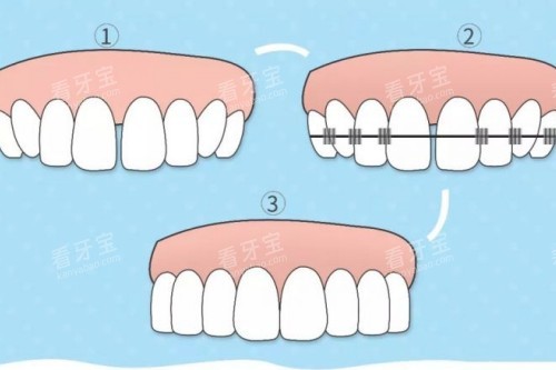 牙齿矫正步骤图 牙齿矫正步骤图