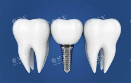 种植体与真实牙齿对比漫画图 种植体与真实牙齿对比漫画图