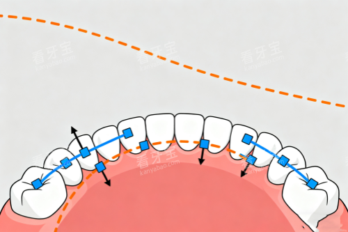 牙齿矫正概念图 牙齿矫正概念图