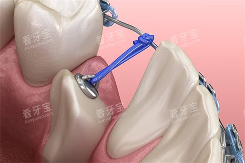 下颌单颗牙齿牵引 下颌单颗牙齿牵引