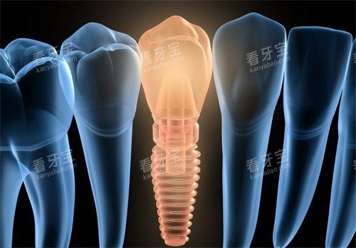 单颗种植牙动画图 单颗种植牙动画图