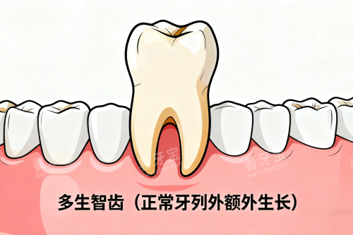 多生智齿展示图 多生智齿展示图