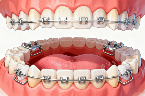 牙齿矫正模型图一览 牙齿矫正模型图一览