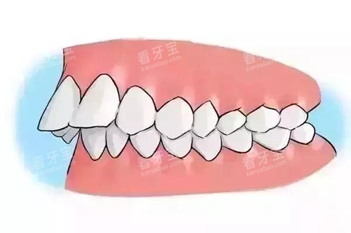 深覆合牙齿突出卡通示意图 深覆合牙齿突出卡通示意图
