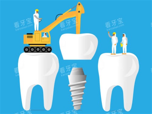 种植牙工程示意图 种植牙工程示意图
