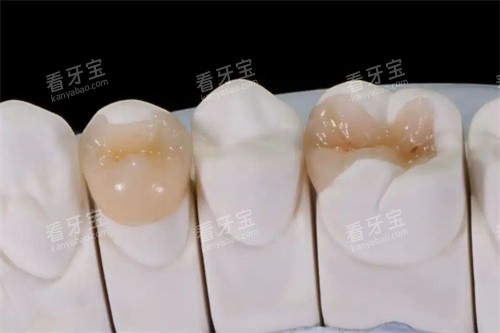 高位嵌体实物图 高位嵌体实物图