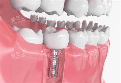 种植牙模型展示图片 种植牙模型展示图片
