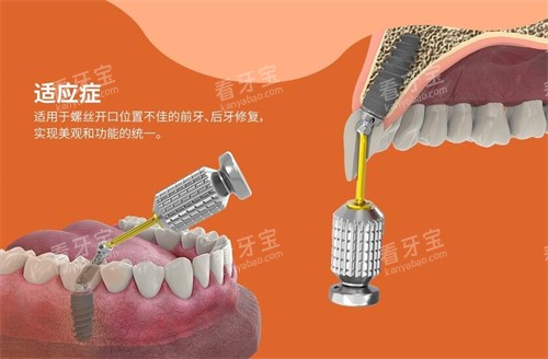 百齿泰植体适应症展示图 百齿泰植体适应症展示图