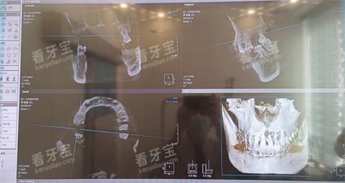 珠海仁爱口腔牙齿拍片 珠海仁爱口腔牙齿拍片
