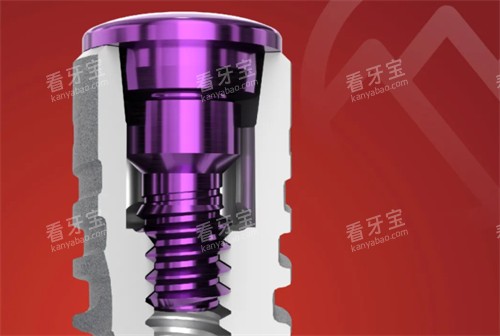 卡尔斯种植牙简介 卡尔斯种植牙简介