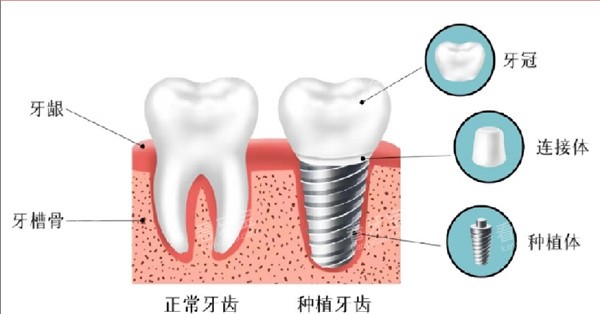 种植牙结构图 种植牙结构图
