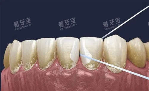牙线清理牙齿缝隙 牙线清理牙齿缝隙