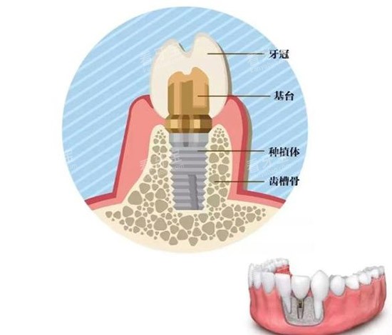 ��ֲ������ṹͼ