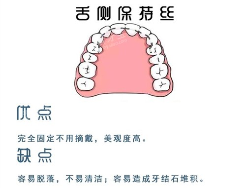 牙齿矫正舌侧保持器优缺点图 牙齿矫正舌侧保持器优缺点图