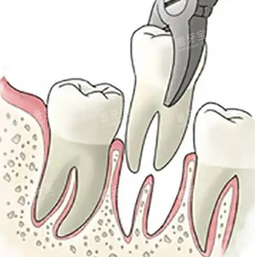 拔牙动画图片 拔牙动画图片