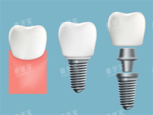 宜昌咿呀中广口腔好不好?超赞!名医团队+AI智能诊疗,种牙矫正效果看得见~
