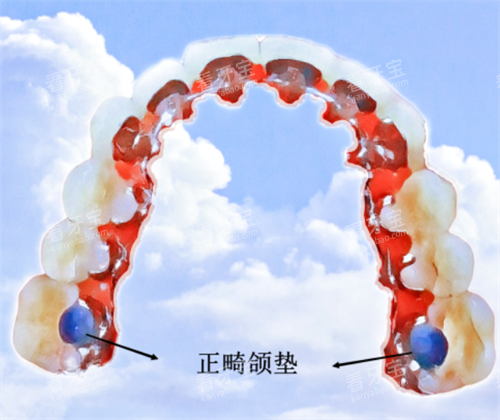 颌垫会改变脸型吗?不涉及骨骼改建,青少年功能性矫治或有侧貌微调,成年患者无需过度担忧!