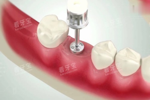 ��ֲ��ֲ�뿨ͨͼƬչʾ