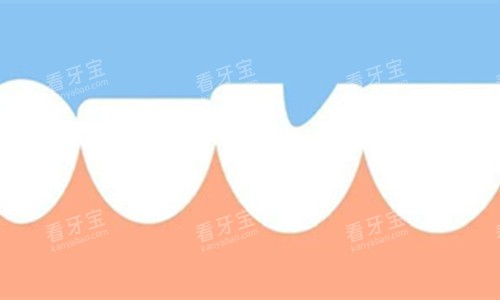 牙齿缺失一块展示图 牙齿缺失一块展示图