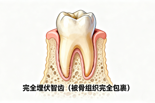 完全埋伏智齿展示图 完全埋伏智齿展示图