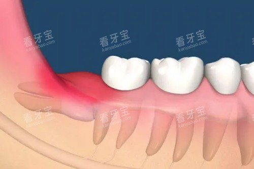 智齿发炎卡通体 智齿发炎卡通体