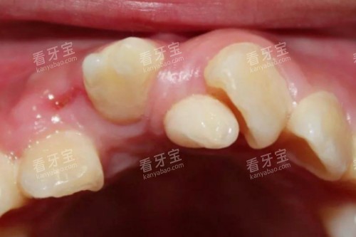 牙齿畸形问题模型图 牙齿畸形问题模型图