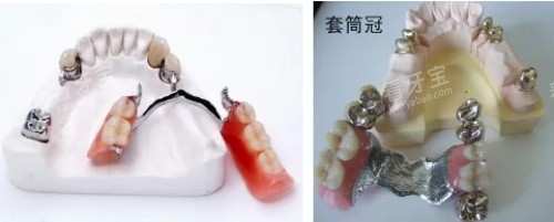 无挂钩假牙展示图 无挂钩假牙展示图