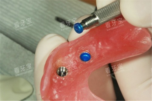 Locator半固定种植牙修复体配件 Locator半固定种植牙修复体配件