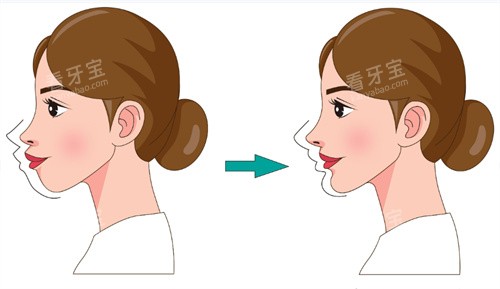 牙齿矫正前后对比卡通图 牙齿矫正前后对比卡通图